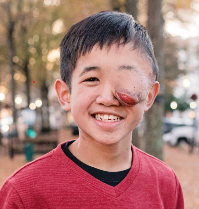 A smiling young boy whose Neurofibromatosis has disfigured his left eye.